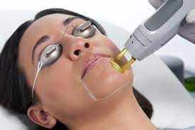 Full face and neck laser
