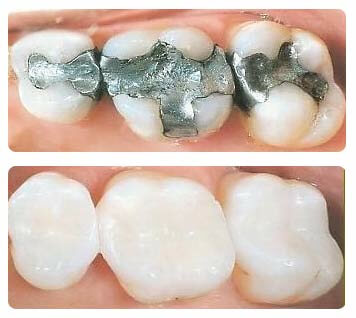 tooth color filling
