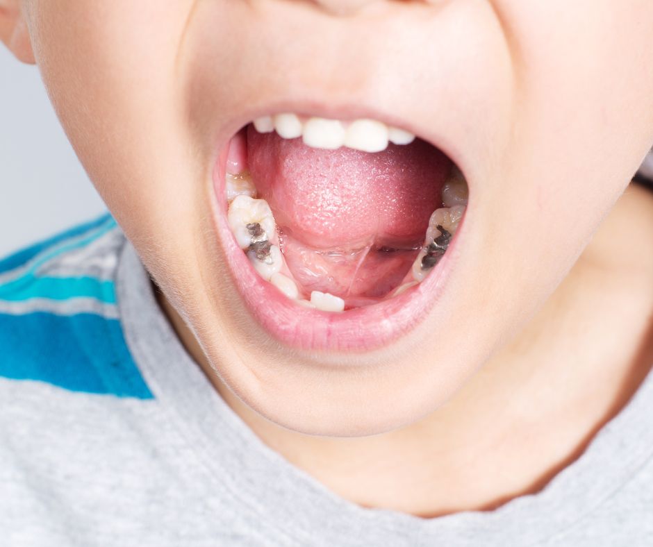kid's teeth filling