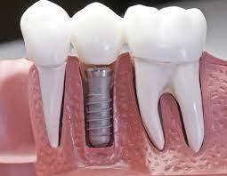 dental implant (100 for every additional bone)