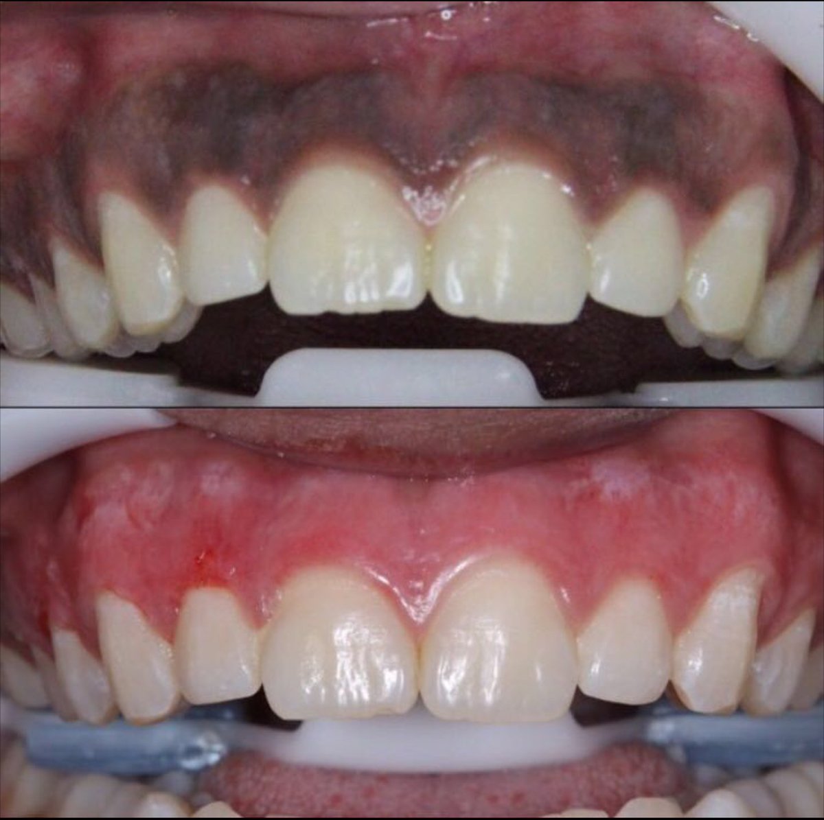 Gum De-pigmentation (per jaw)