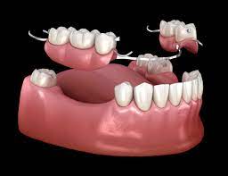 partial  Dentures (10 added  for single tooth)